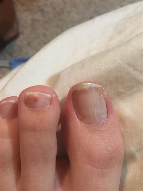 reddit nail fungus